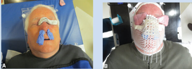 brachytherapy for skin cancer