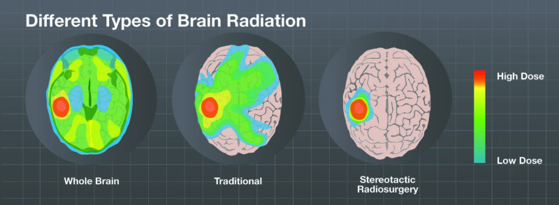 radiotherapy for brain tumor