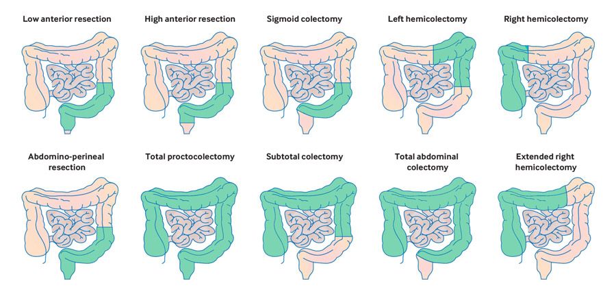 colectomy