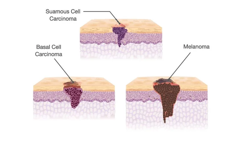 skin cancer