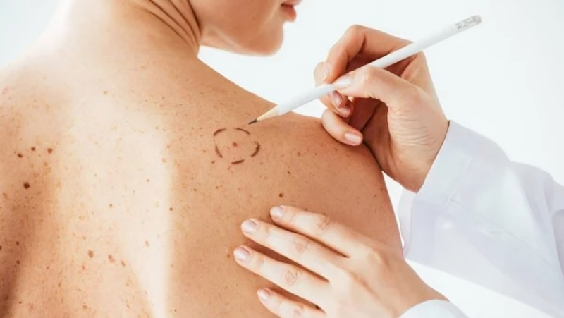 Transforming Melanoma Treatment in Manchester – Manchester Cancer Research Centre