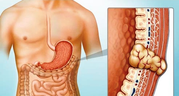 Gastrointestinal stromal tumor