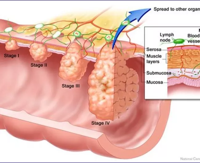 Colorectal cancer