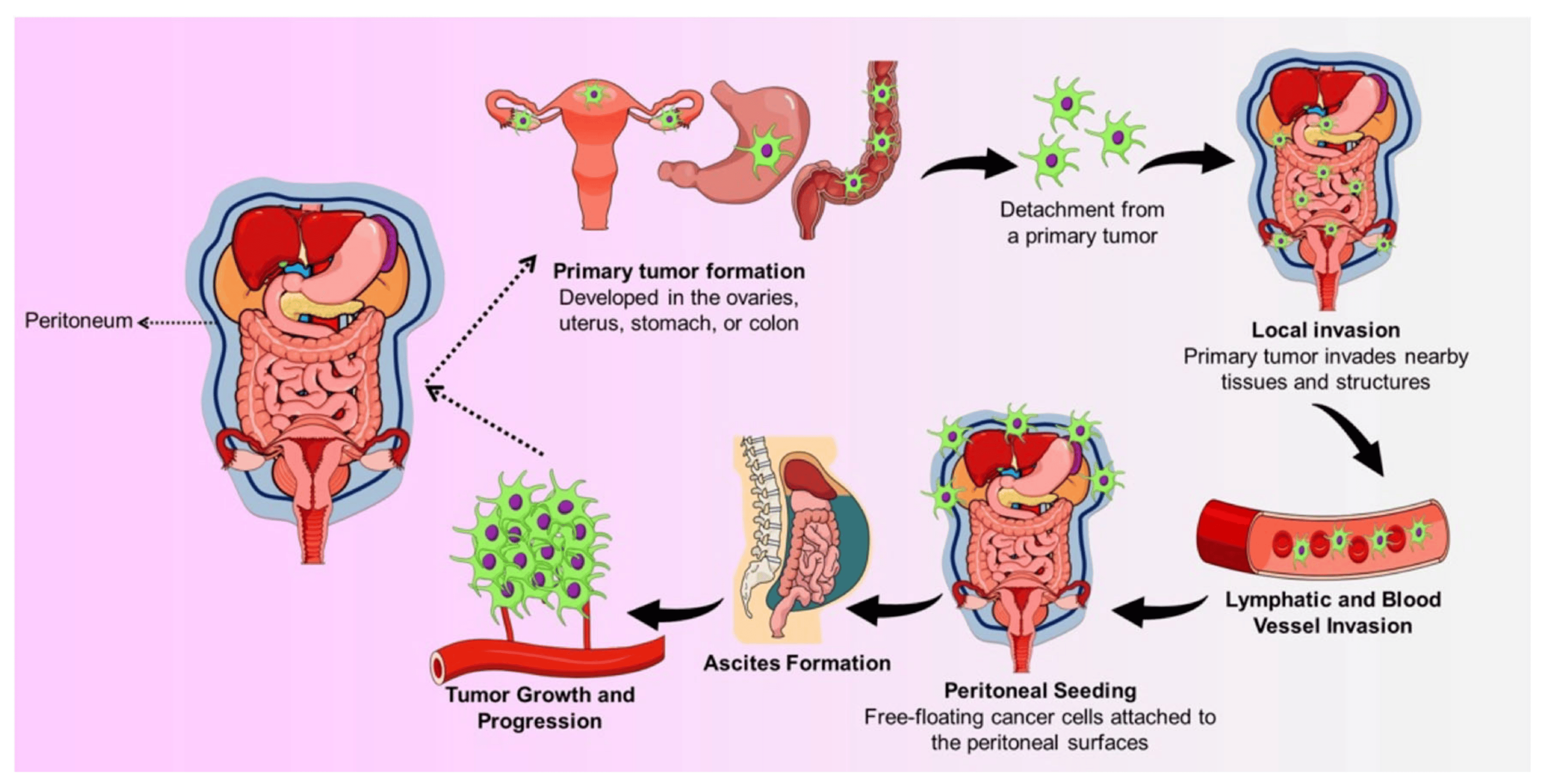 Peritoneal Carcinomatosis of Malignant Gynecological Origi