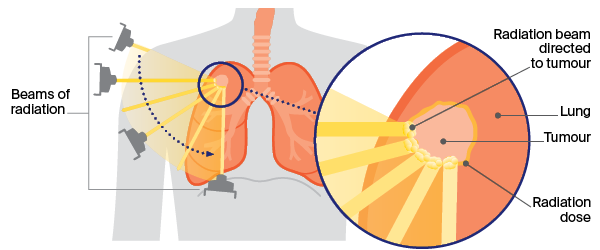 radiotherapy for lung cancer