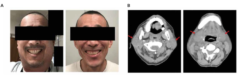 Ocular Side Effects Of CAR-T Cell Therapy