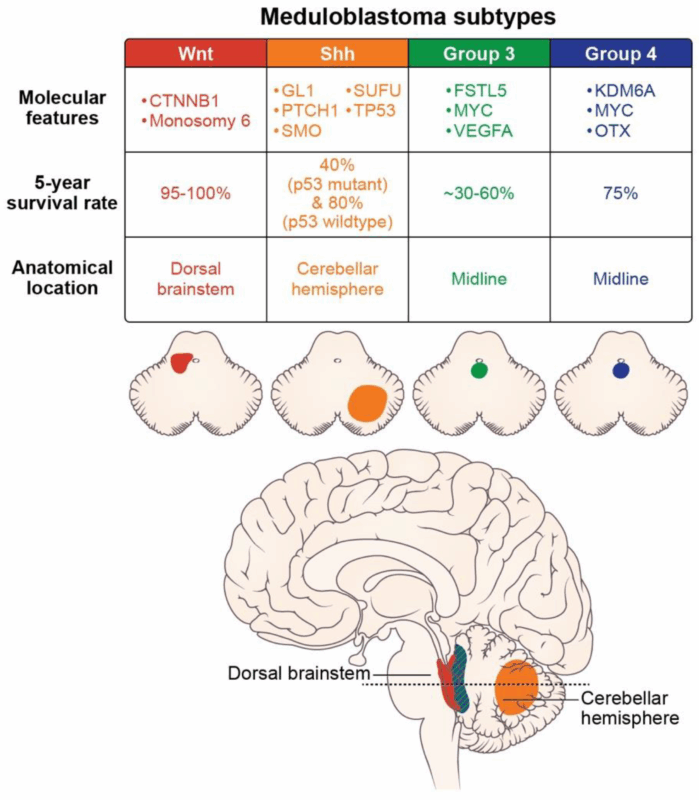 Medulloblastoma-prognosis