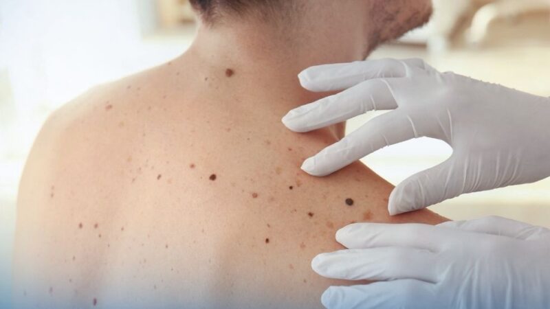 EORTC Shared Phase 2 EORTC-1612 EBIN Trial Results on First-Line Treatment Strategy in BRAF-Mutant Melanoma