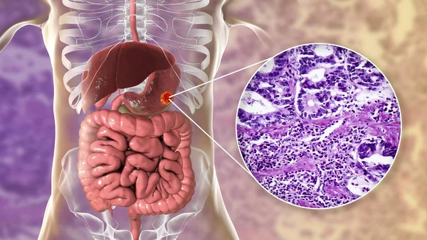 Gastric Cancer and Smoking, Stomach cancer and smoking