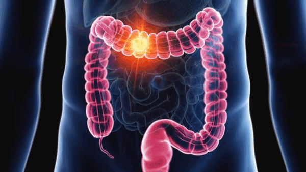 ASCO’s Integrative Oncology Guideline for GI Cancers is Free to Access! – Society for Integrative Oncology