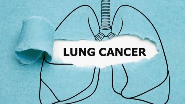 Many Lung Cancers Are Now in Nonsmokers – FlorezLab