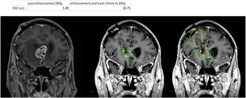 Stereotactic Radiosurgery