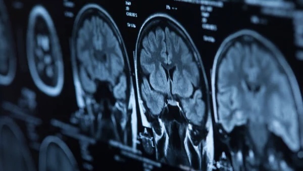 Abhijit Das: Basic Facts For Residents About Diffuse Gliomas