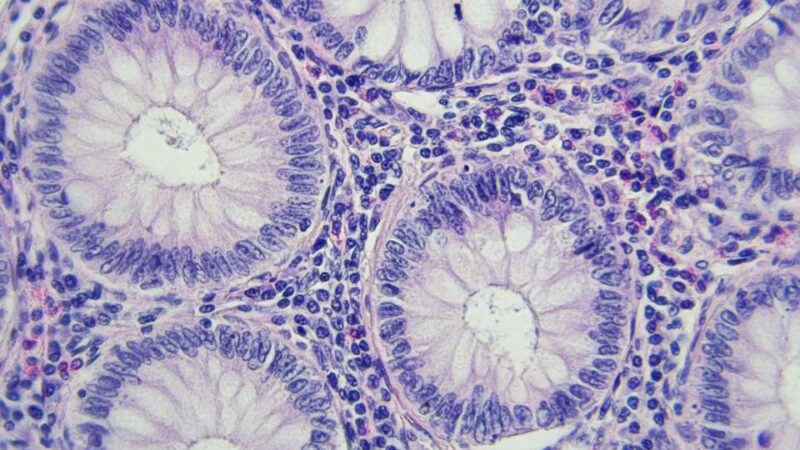 Combination of Immunotherapy and Targeted Therapy Improves Survival for Patients with Advanced CRC