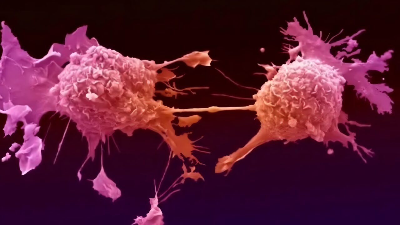The World’s First Trial of a Vaccine to Prevent Lung Cancer – Cancer Research UK