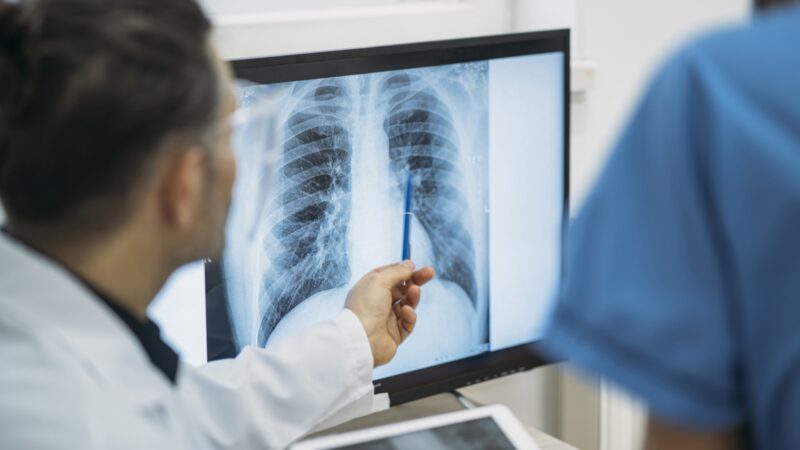 Lung Cancer Is Deadly, But There Is Hope: Here’s What Surgeons Want You to Know