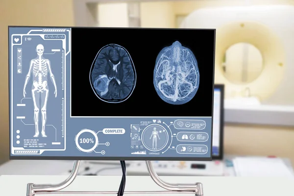 glioblastoma