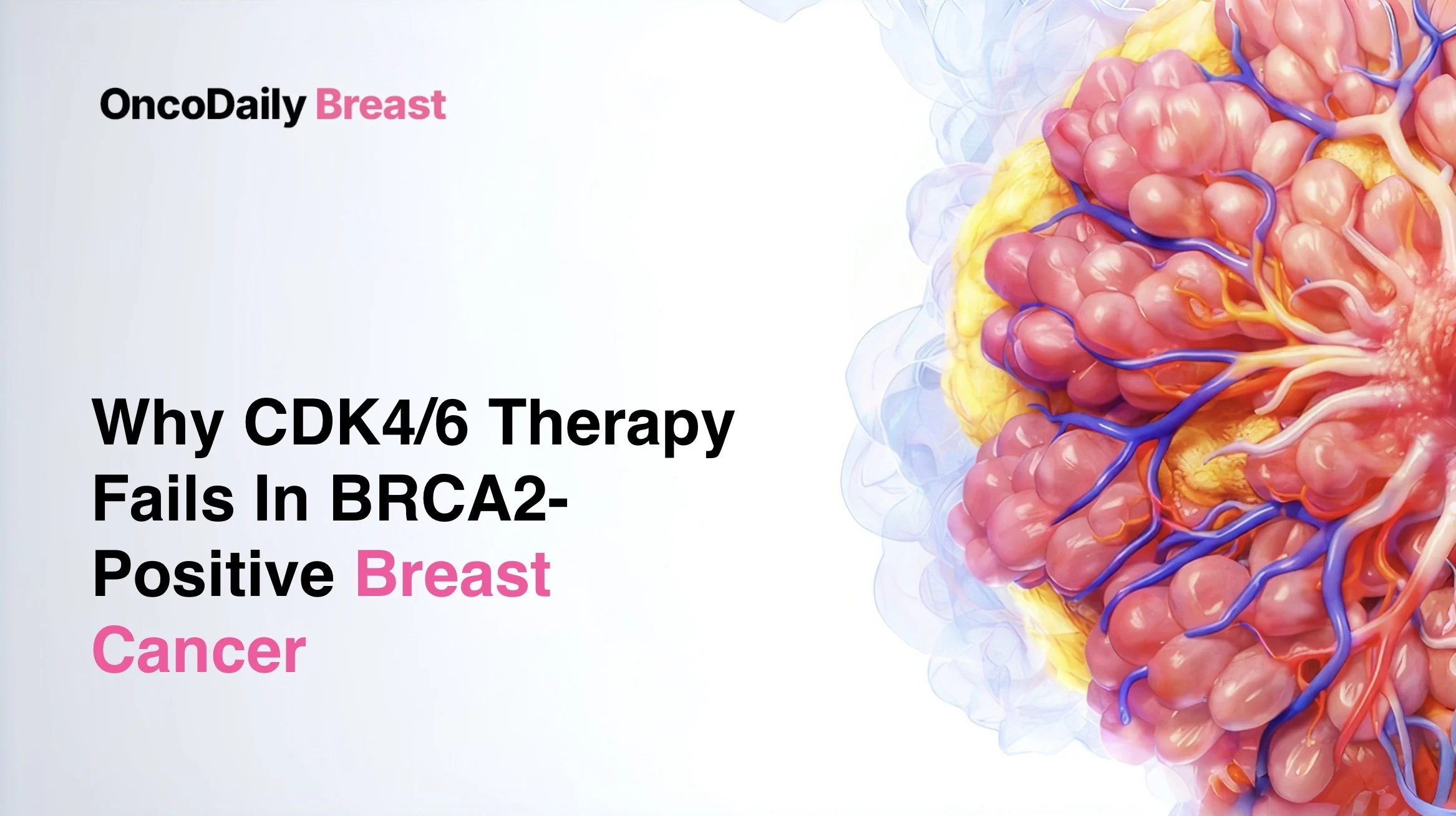 BRCA2-Driven Breast Cancer