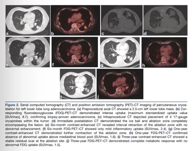 Cryoablation