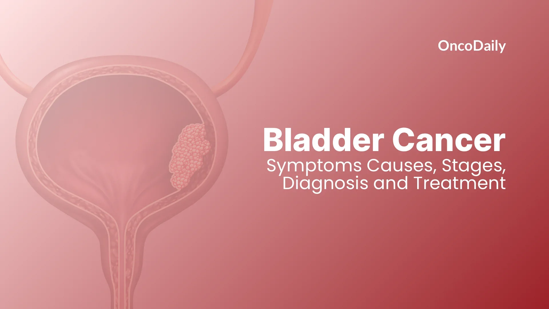 bladder cancer