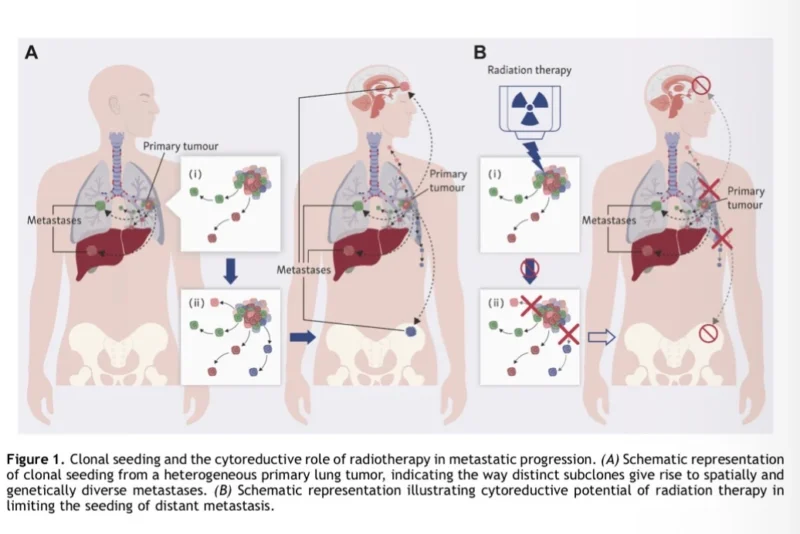 Definitive Radiotherapy