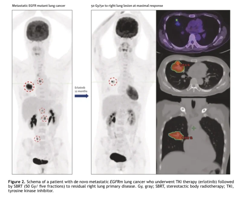 Definitive Radiotherapy