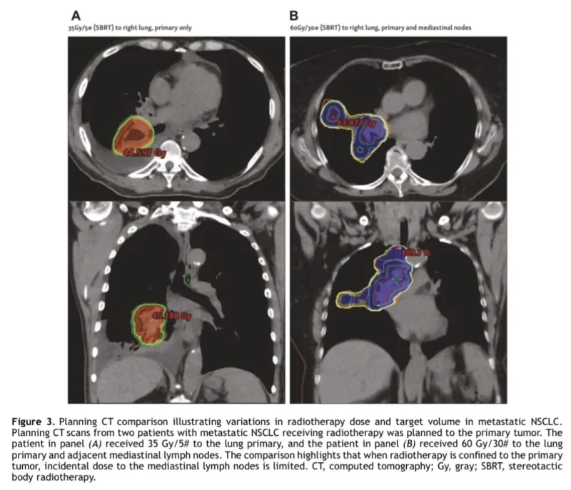 Definitive Radiotherapy