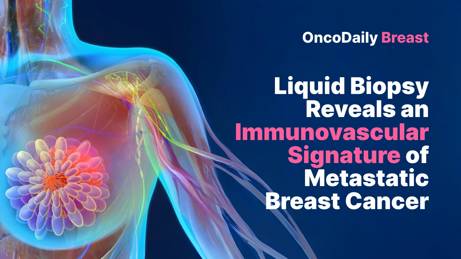 Metastatic Breast Cancer