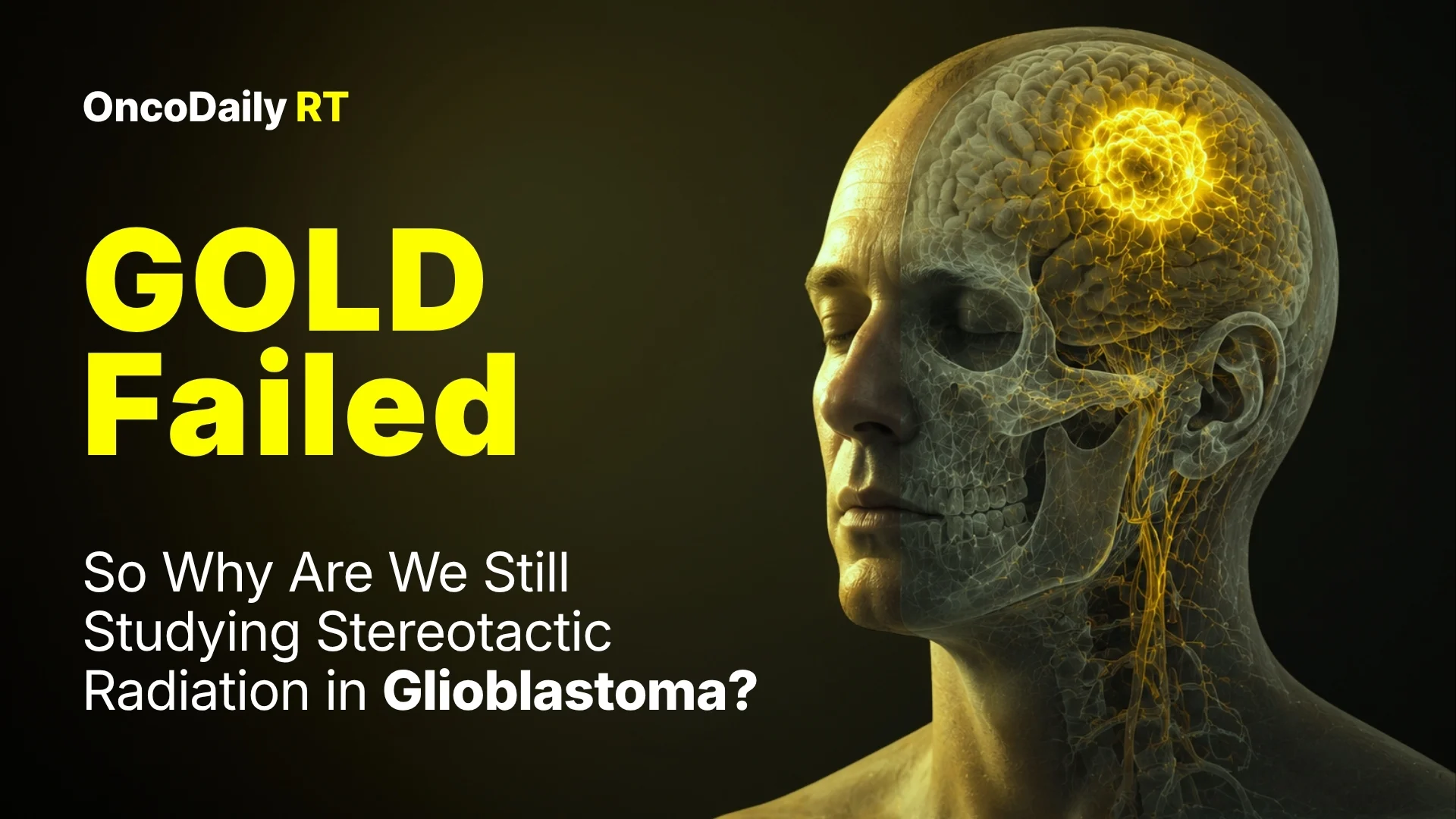 glioblastoma