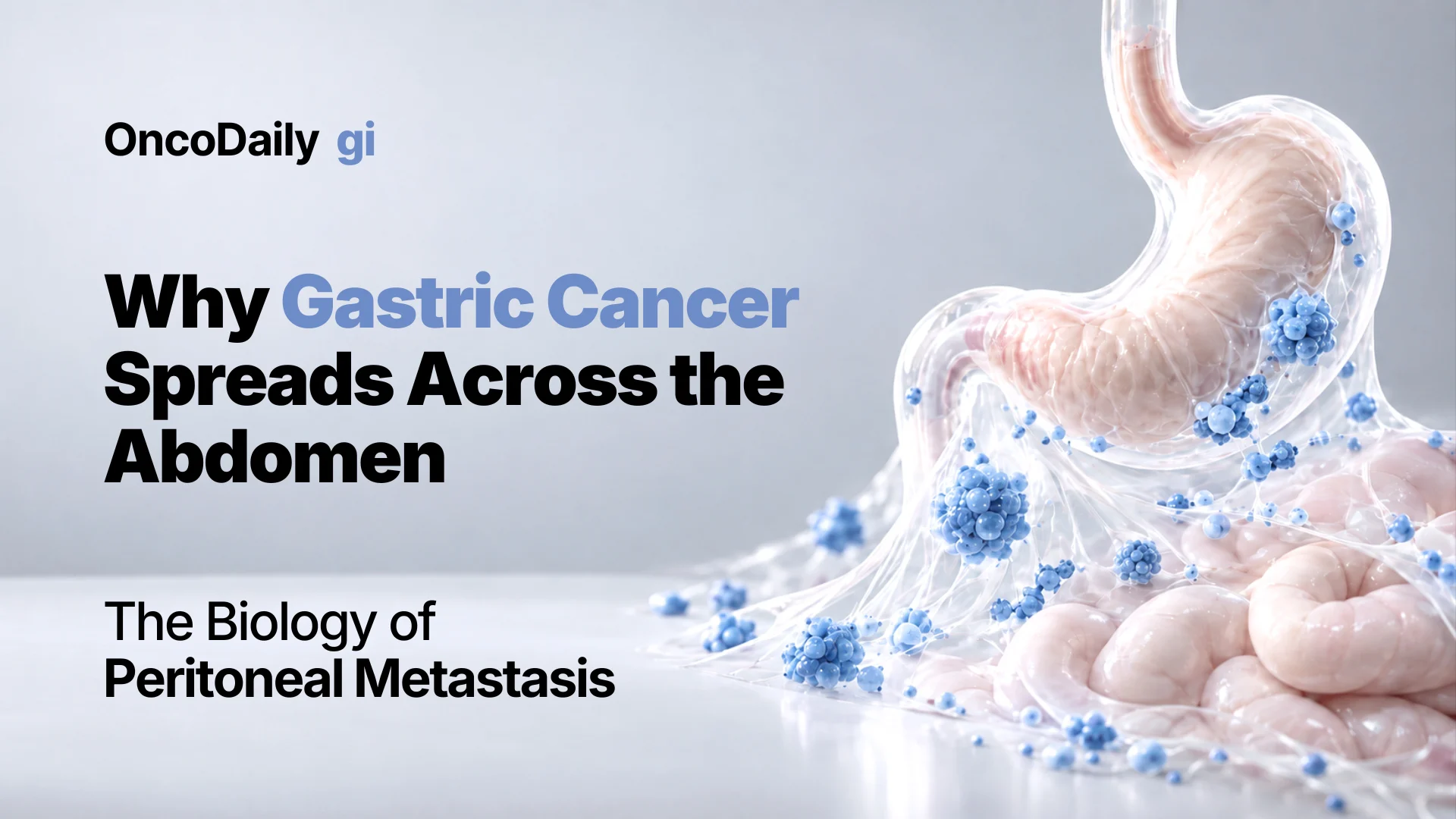Why Gastric Cancer Spreads Across the Abdomen: The Biology of Peritoneal Metastasis